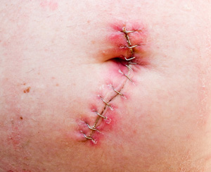 AlloDerm Hernia Mesh Sugery