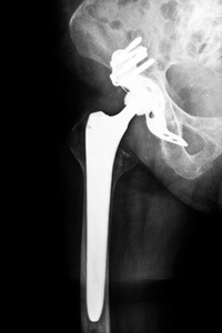Biomet Hip Recall