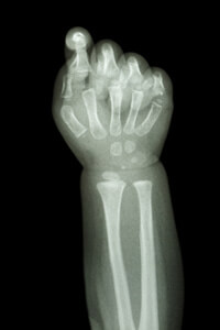 Erb's Palsy Birth Injury