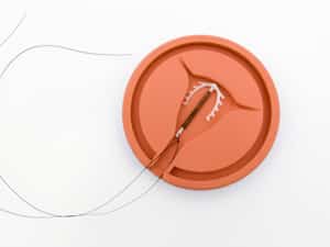 intrauterine device injury